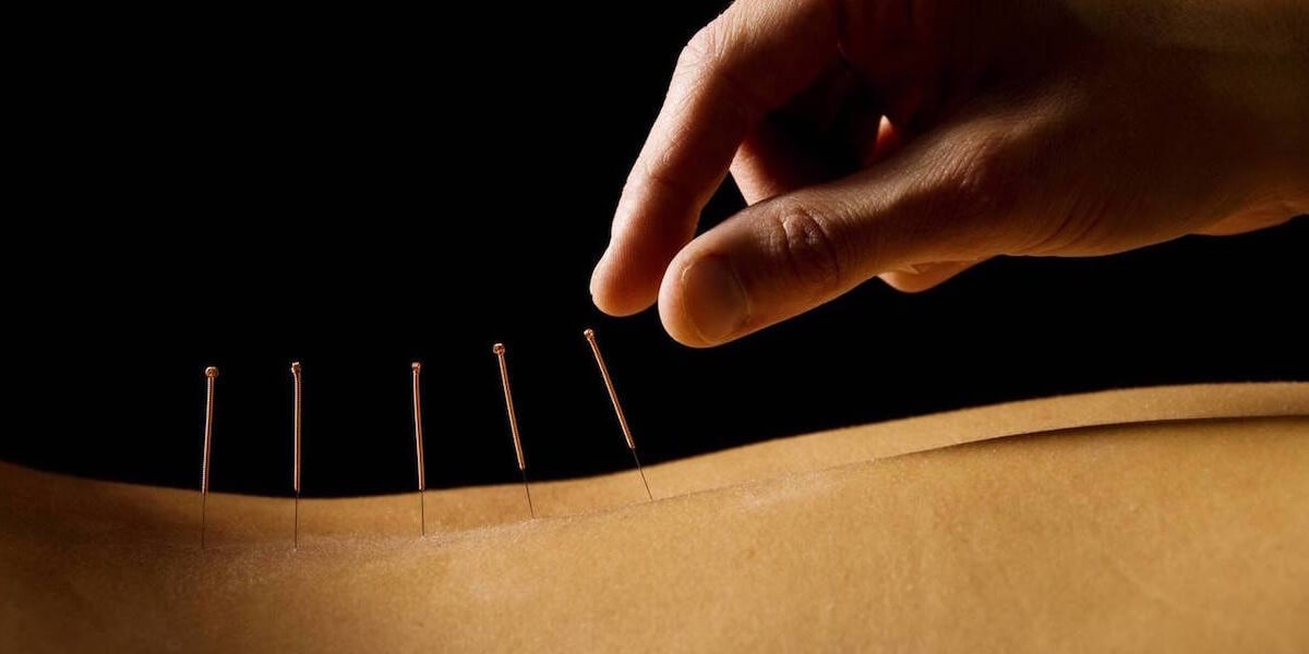 Dry needling & Acupuncture in Perth service photo